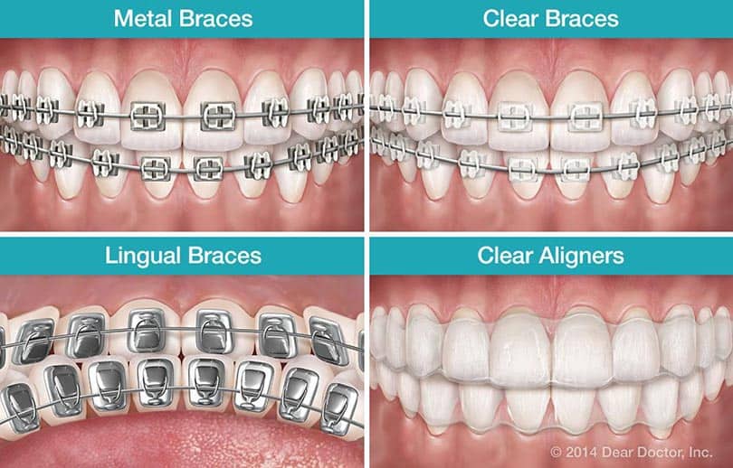 Dental braces types vietnam viethungdent viethunggroup